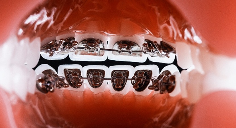 Implant dentar