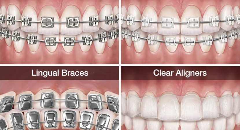 Tipuri de aparate dentare