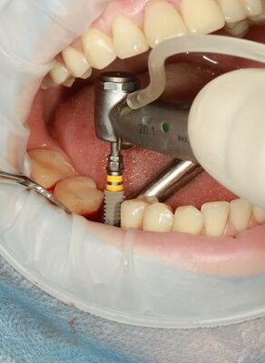 Implantul dentar