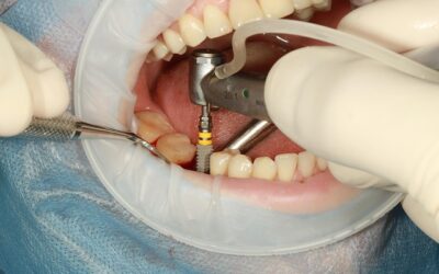 Implantul dentar