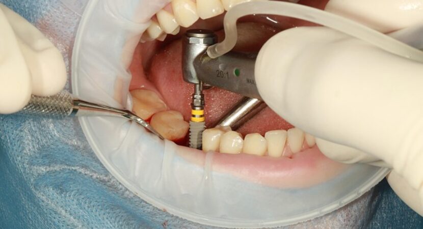 Implantul dentar
